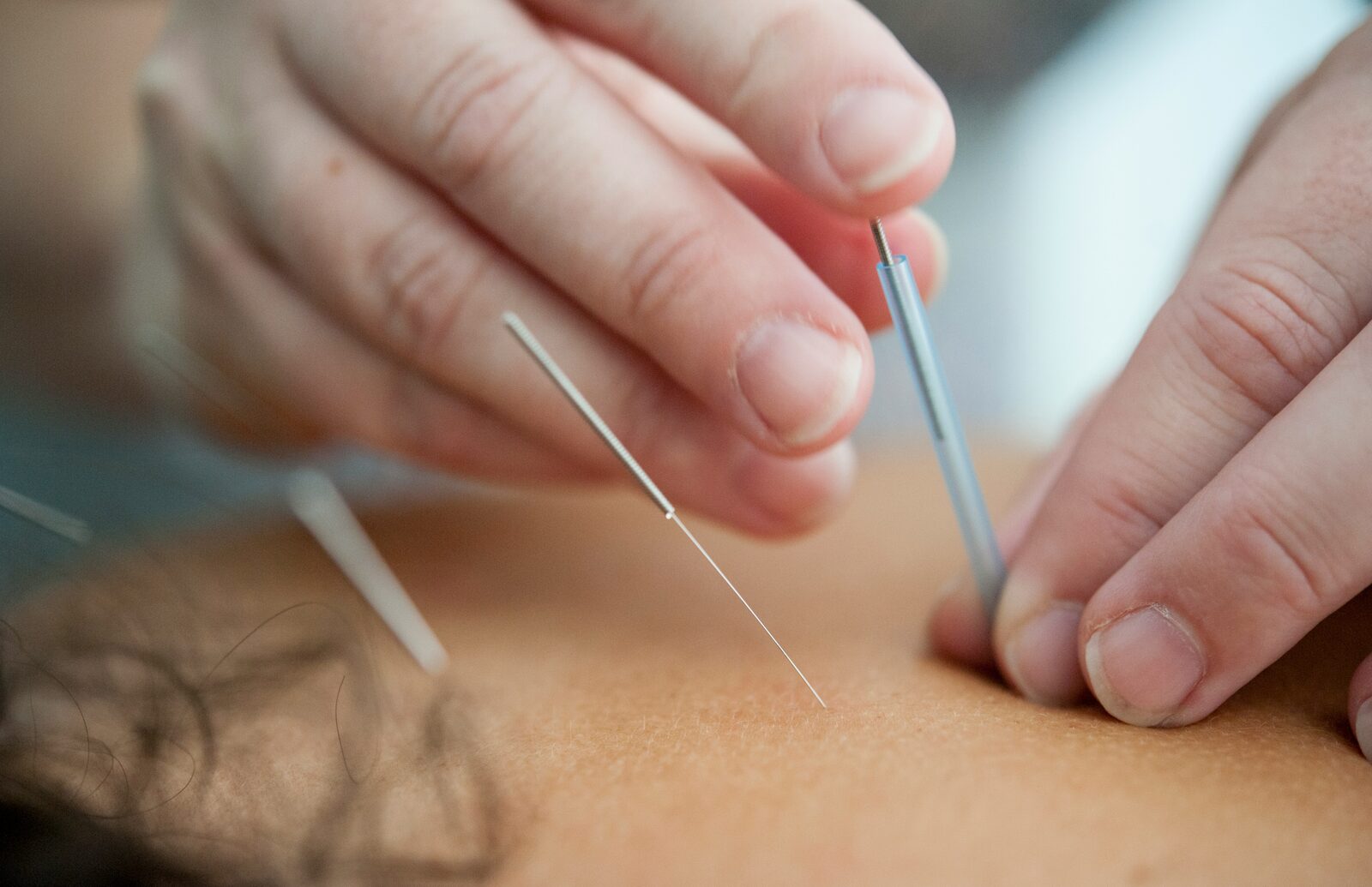 Close-up of acupuncture needle placement