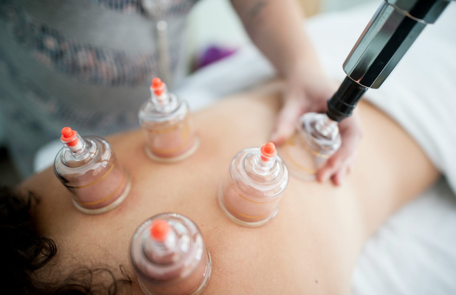 Pain relief acupuncture treatment
